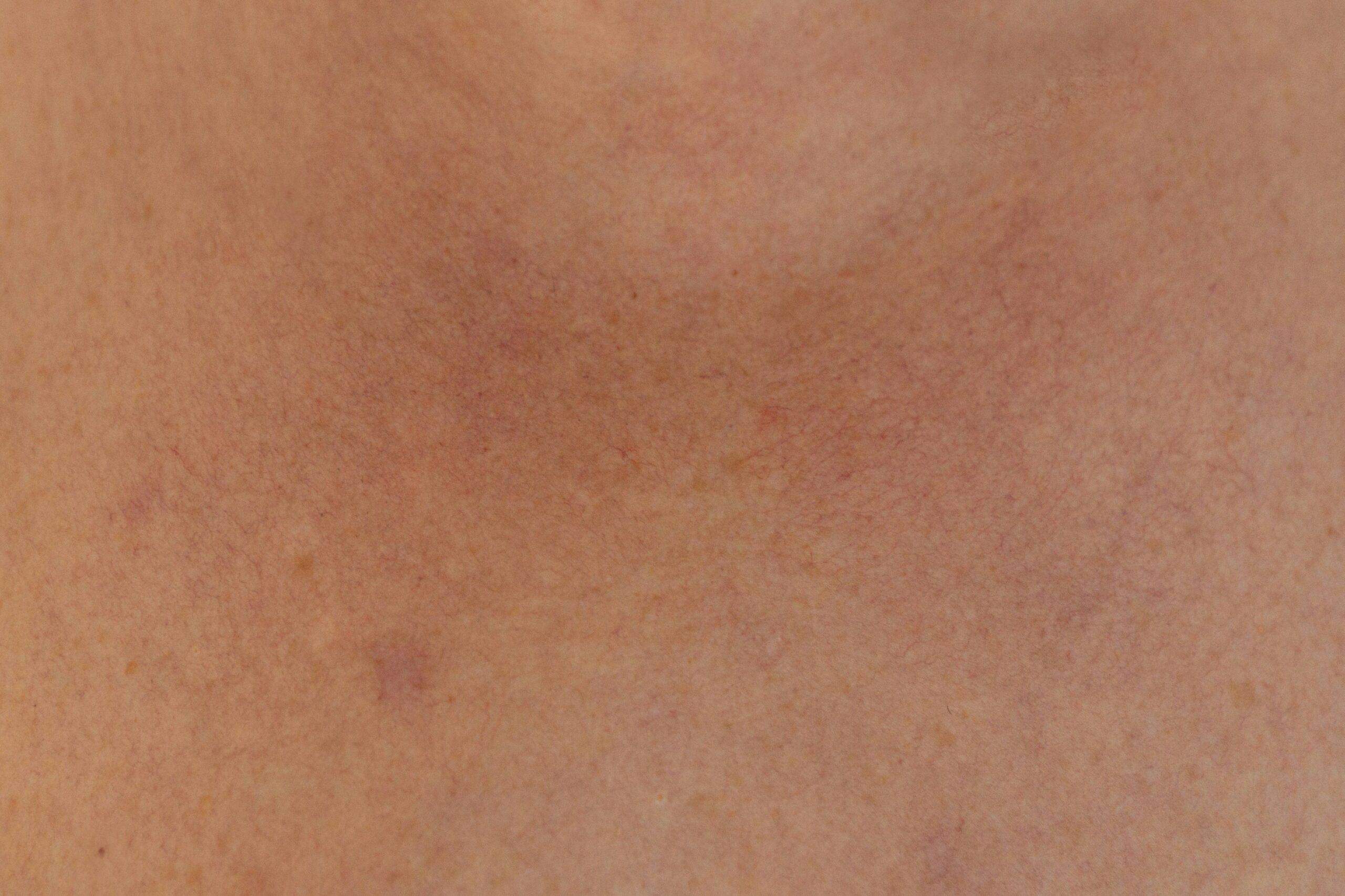 Before and after photos showing skin improvement after using fall flower skincare